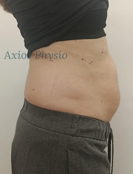 INDIBA treatment baseline, before first session, side view, Axios Physio Swords