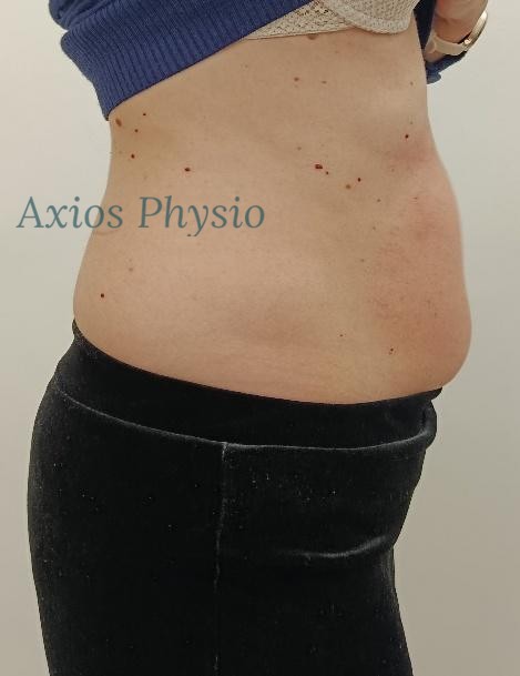 INDIBA treatment result after 10 sessions, side view, Axios Physio Swords