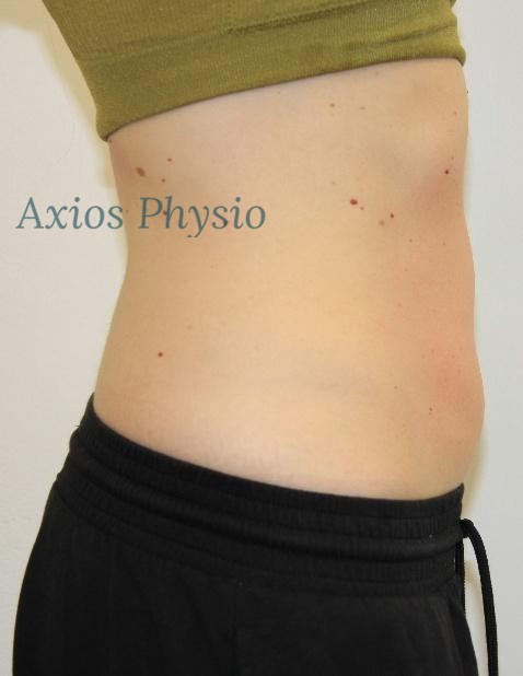 INDIBA treatment result after 20 sessions, side view, Axios Physio Swords