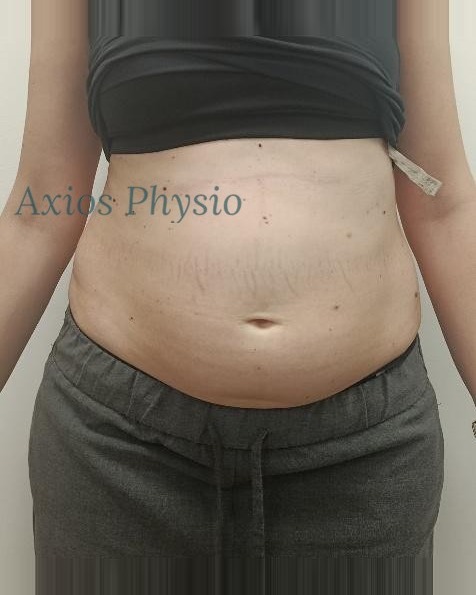 INDIBA treatment baseline, before first session, front view, Axios Physio Swords