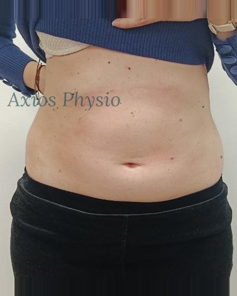 INDIBA treatment result after 10 sessions, front view, Axios Physio Swords