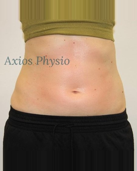 INDIBA treatment result after 20 sessions, front view, Axios Physio Swords